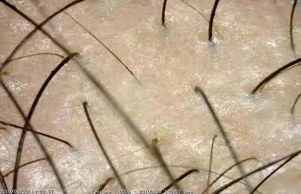 头皮护理产品功效测试